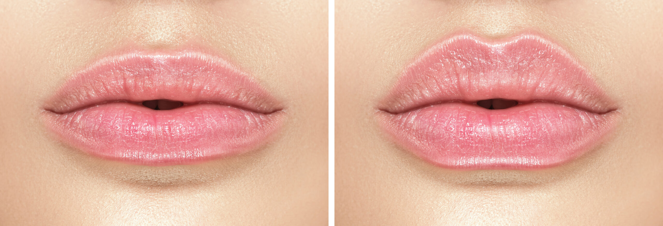 Before,And,After,Lip,Filler,Injections.,Fillers.,Lip,Augmentation,Beautiful